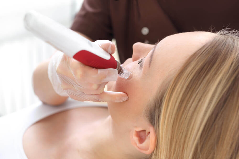 Microneedling side view pic