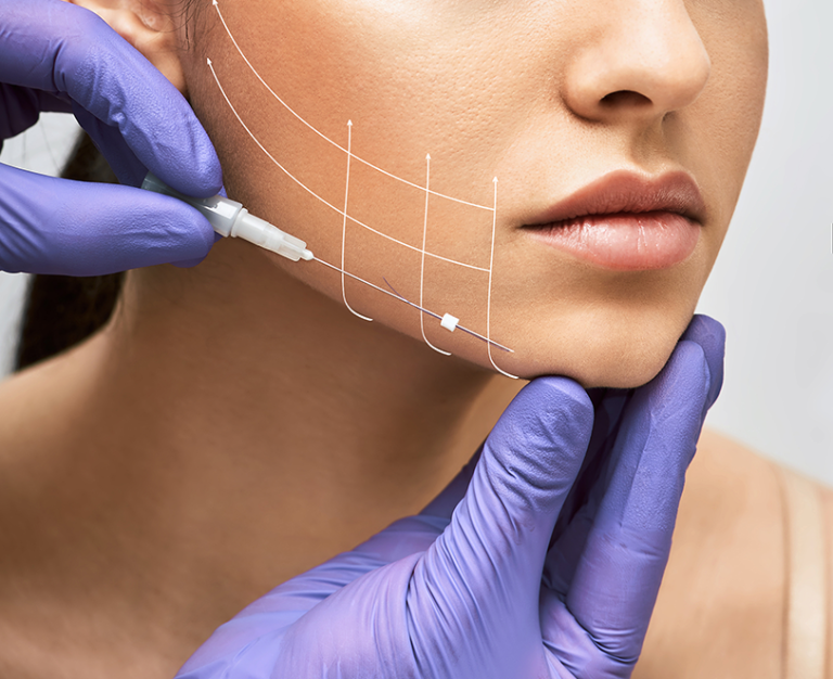 PDO Thread Treatment at Ageless 360 Medical Aesthetics