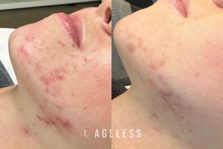 Acne Facial before and after