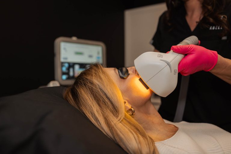 IPL Photofacial treatment Indianapolis