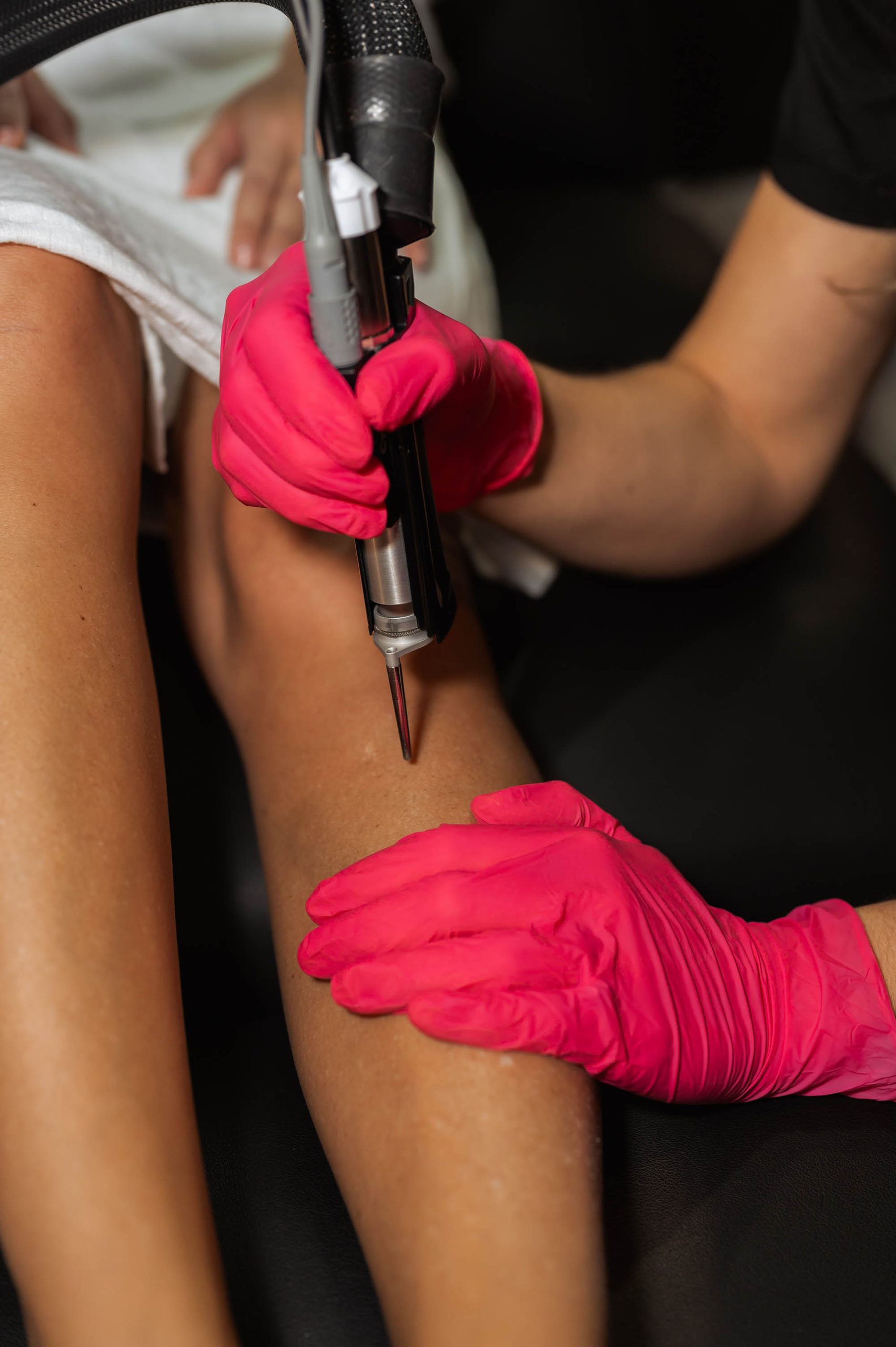 laser hair removal on legs