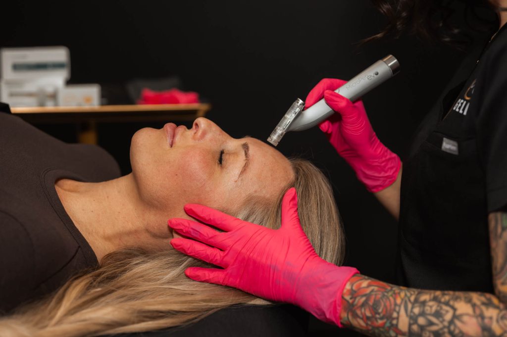 client receiving microneedling in Indianapolis