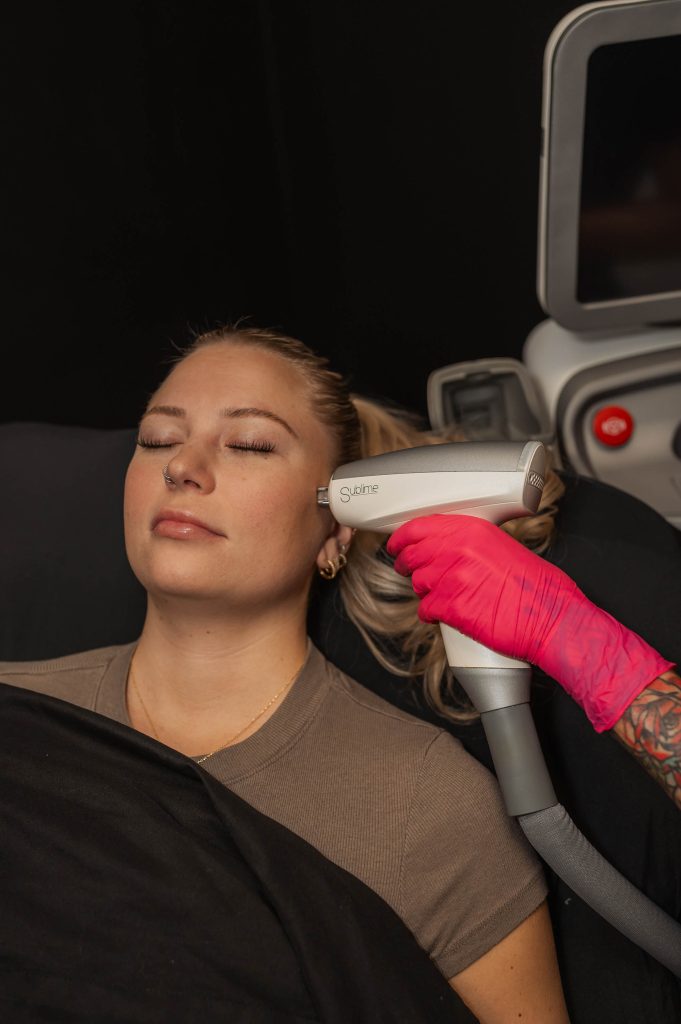 IPL Photofacial treatment Indianapolis