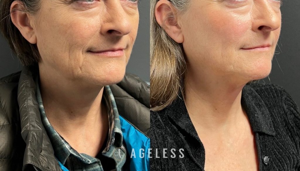 Biostimulator before and after