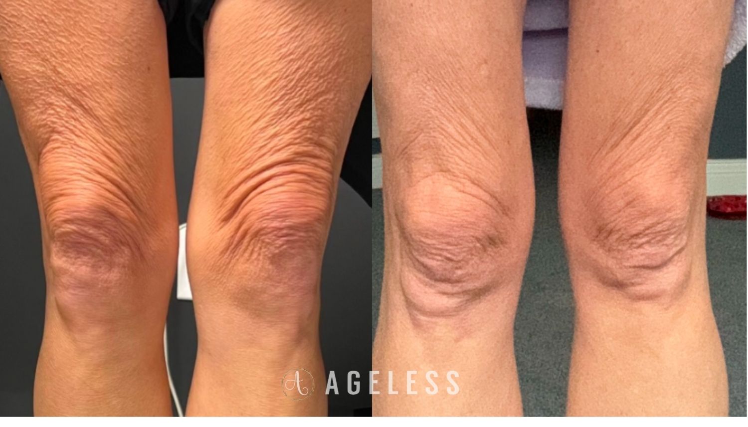 Biostimulator to knees before and after