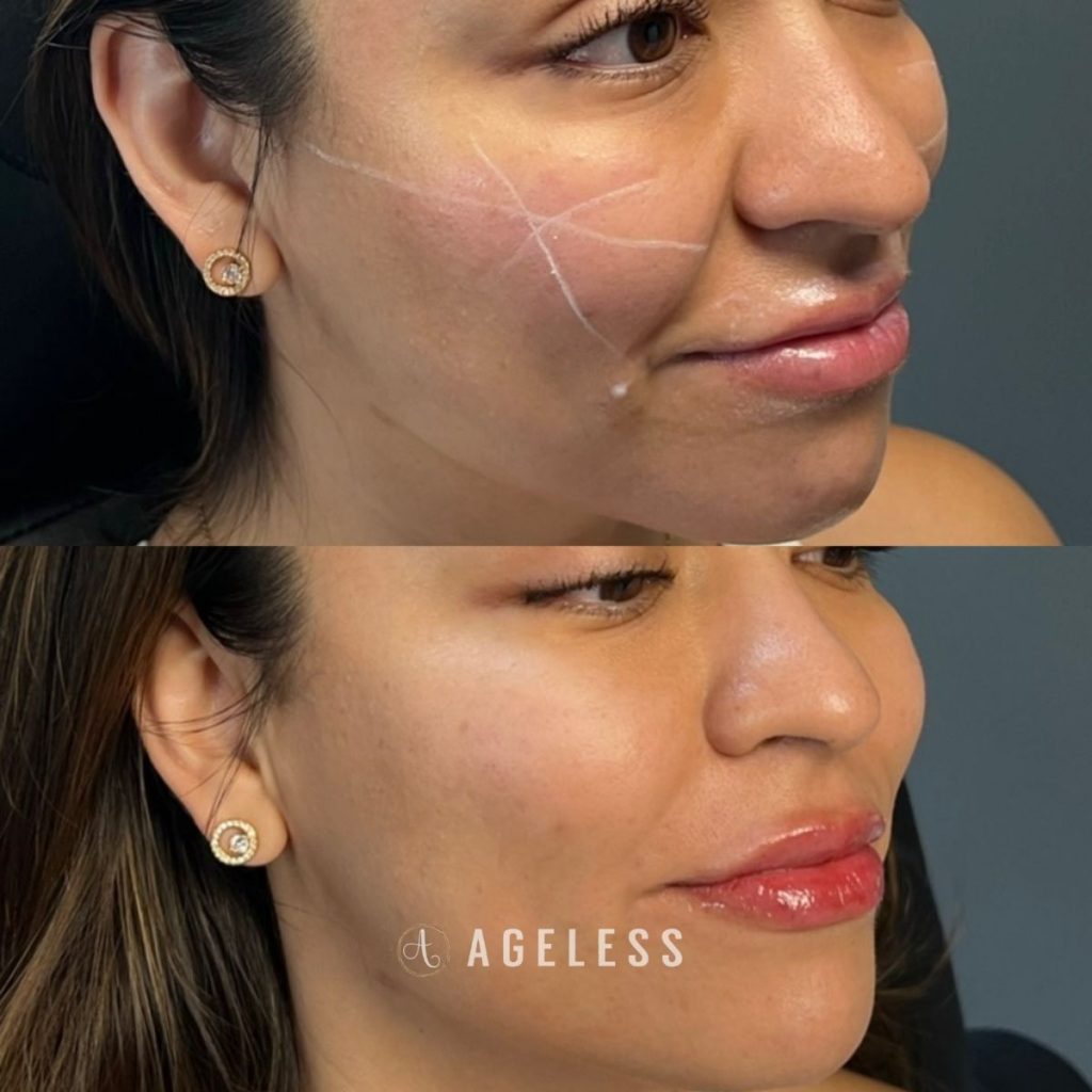 Cheek filler before and after