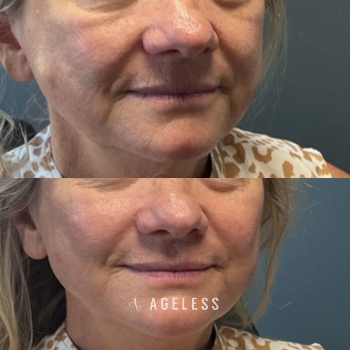 Cheek and perioral filler before and after