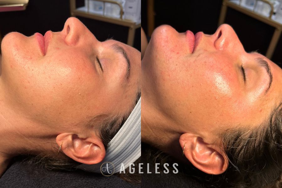 Dermaplane, chemical peel before and after