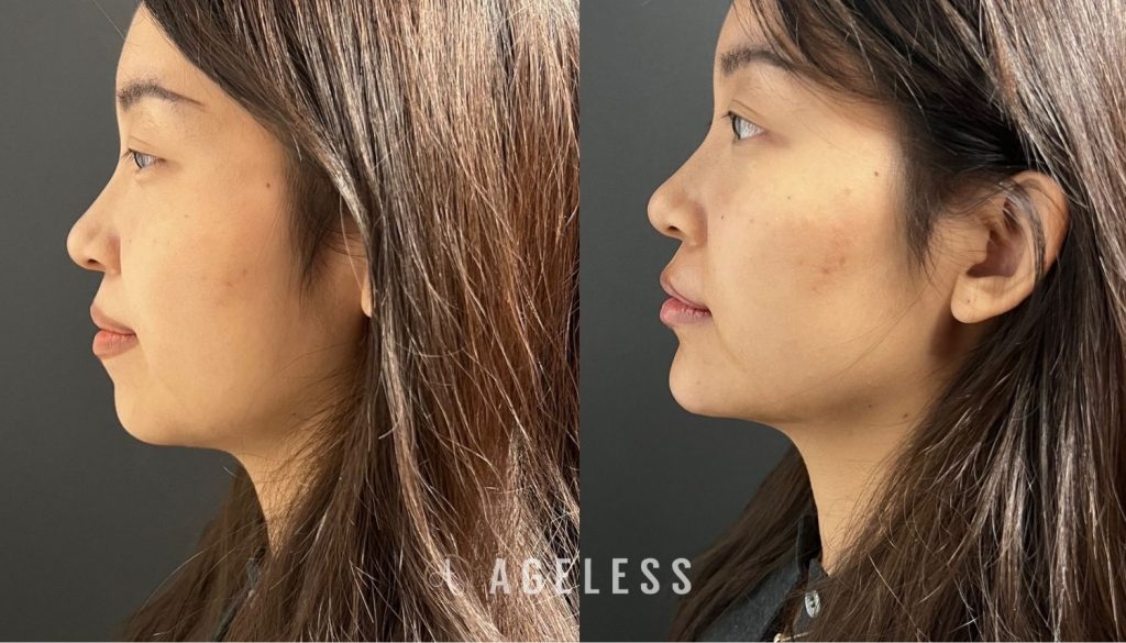 Facial Balancing dermal filler before and after