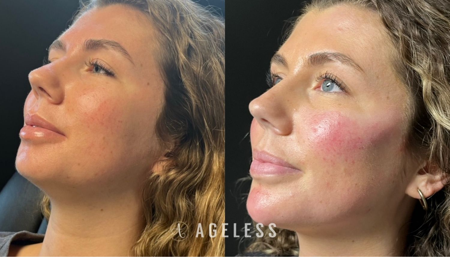 Facial Balancing dermal filler before and after
