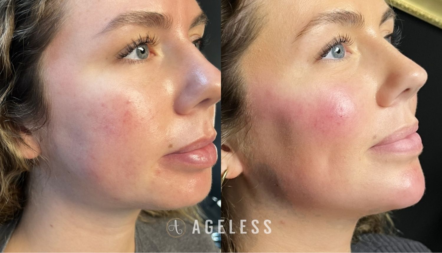 Facial Balancing dermal filler before and after