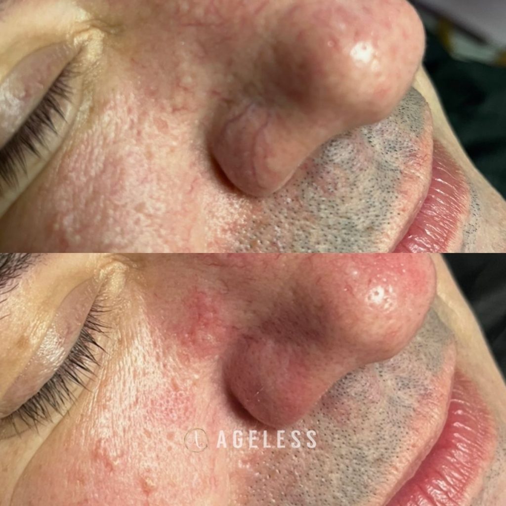 IPL Capillaries before and after