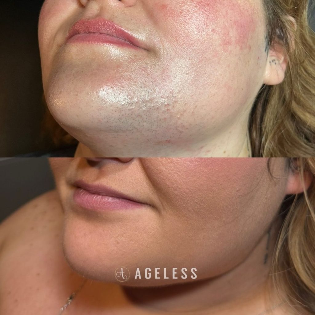 Laser Hair Removal before and after