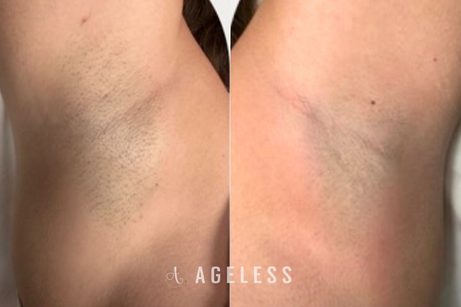 Laser Hair removal one session