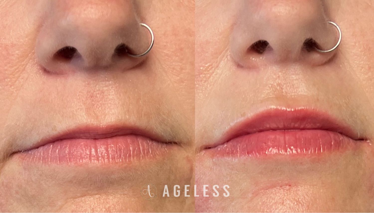 Lip Filler before and after
