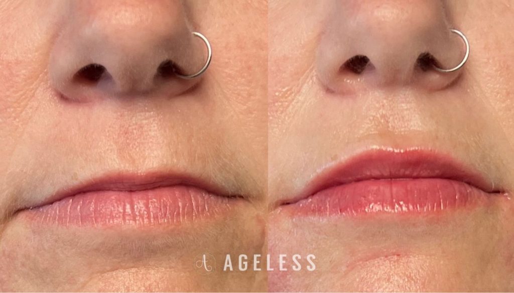 Lip Filler before and after