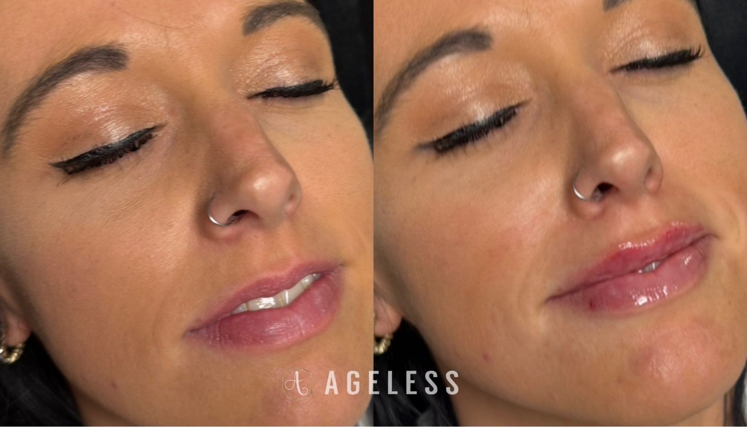 Lip Filler before and after