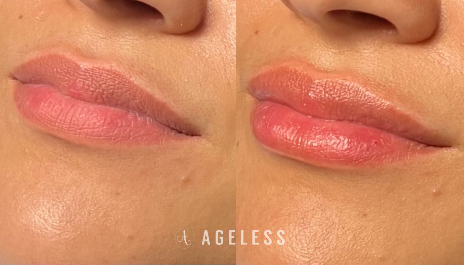 Lip Filler before and after