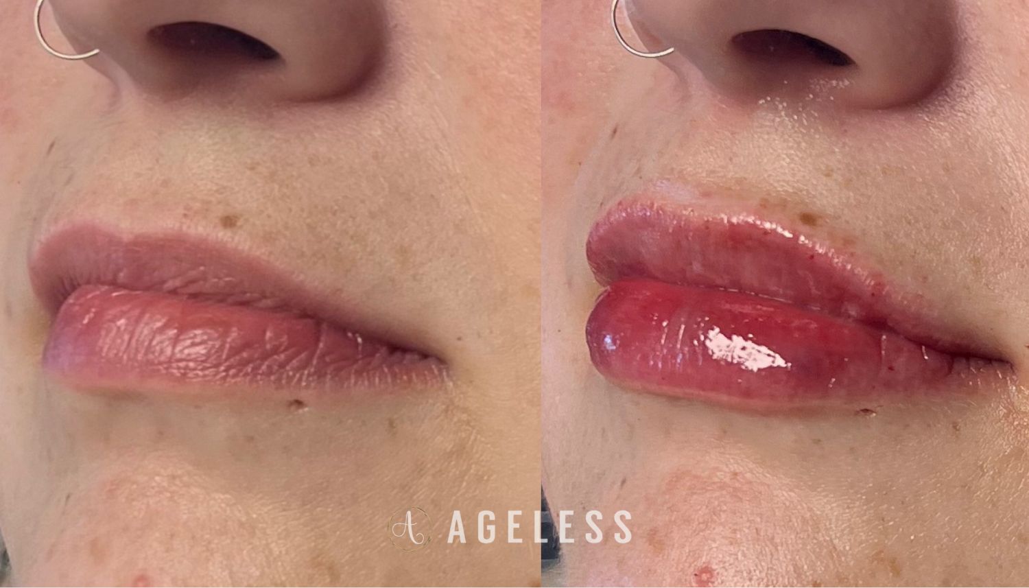 Lip Filler before and after