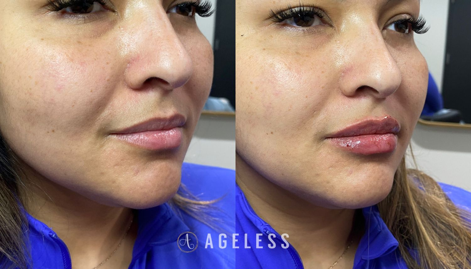 Lip Filler before and after