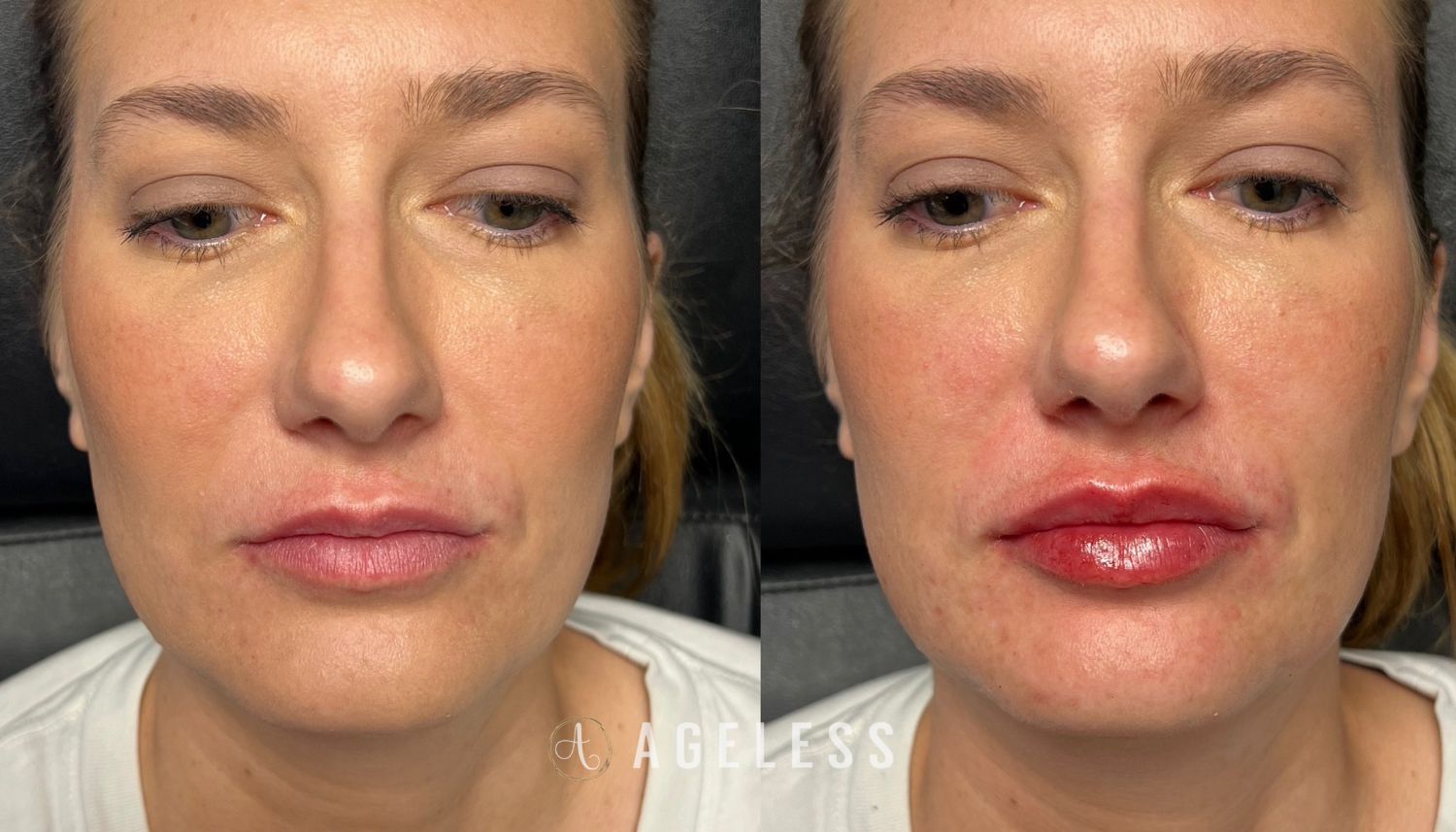 Lip Filler before and after