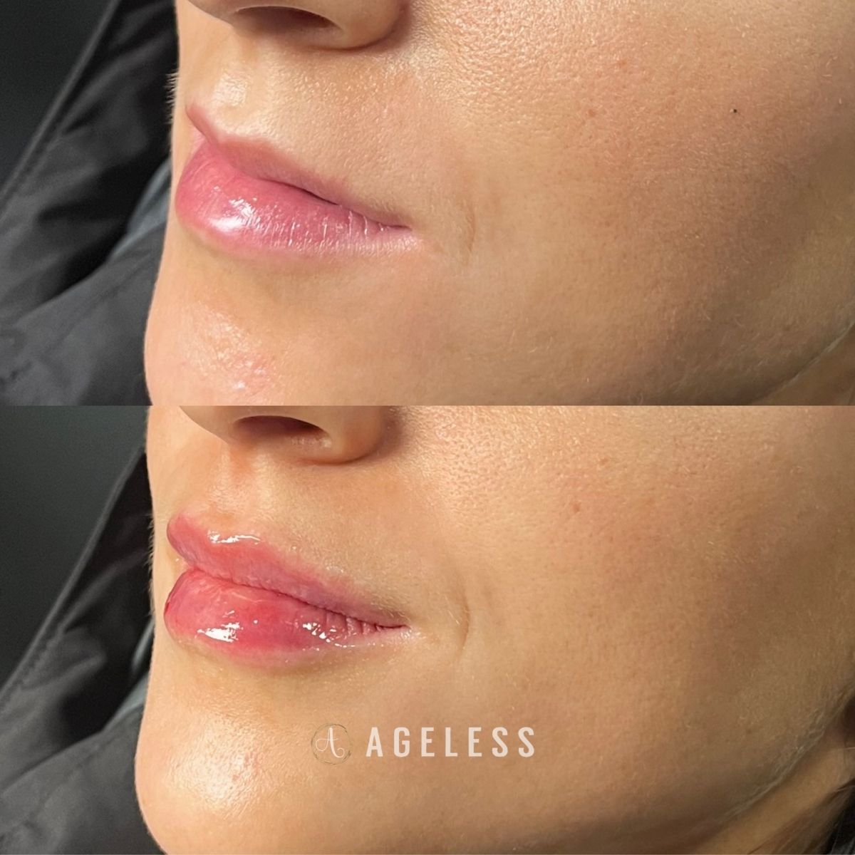 Lip filler before and after