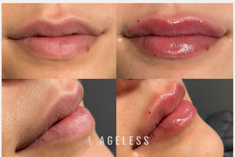 Lip Filler before and after