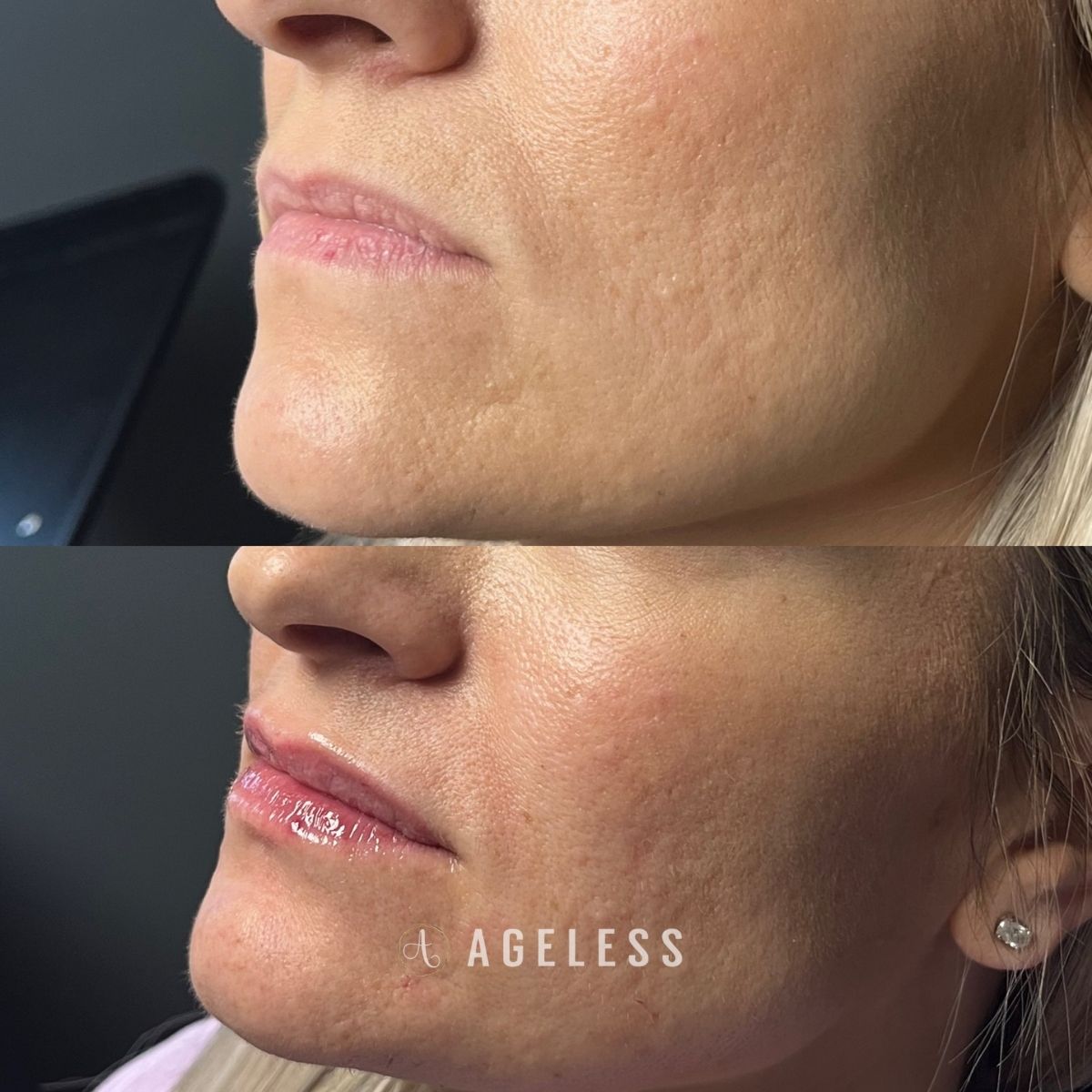 Lip filler before and after