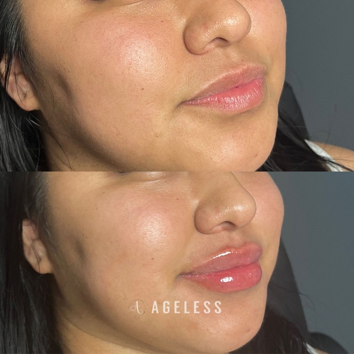 Lip filler before and after