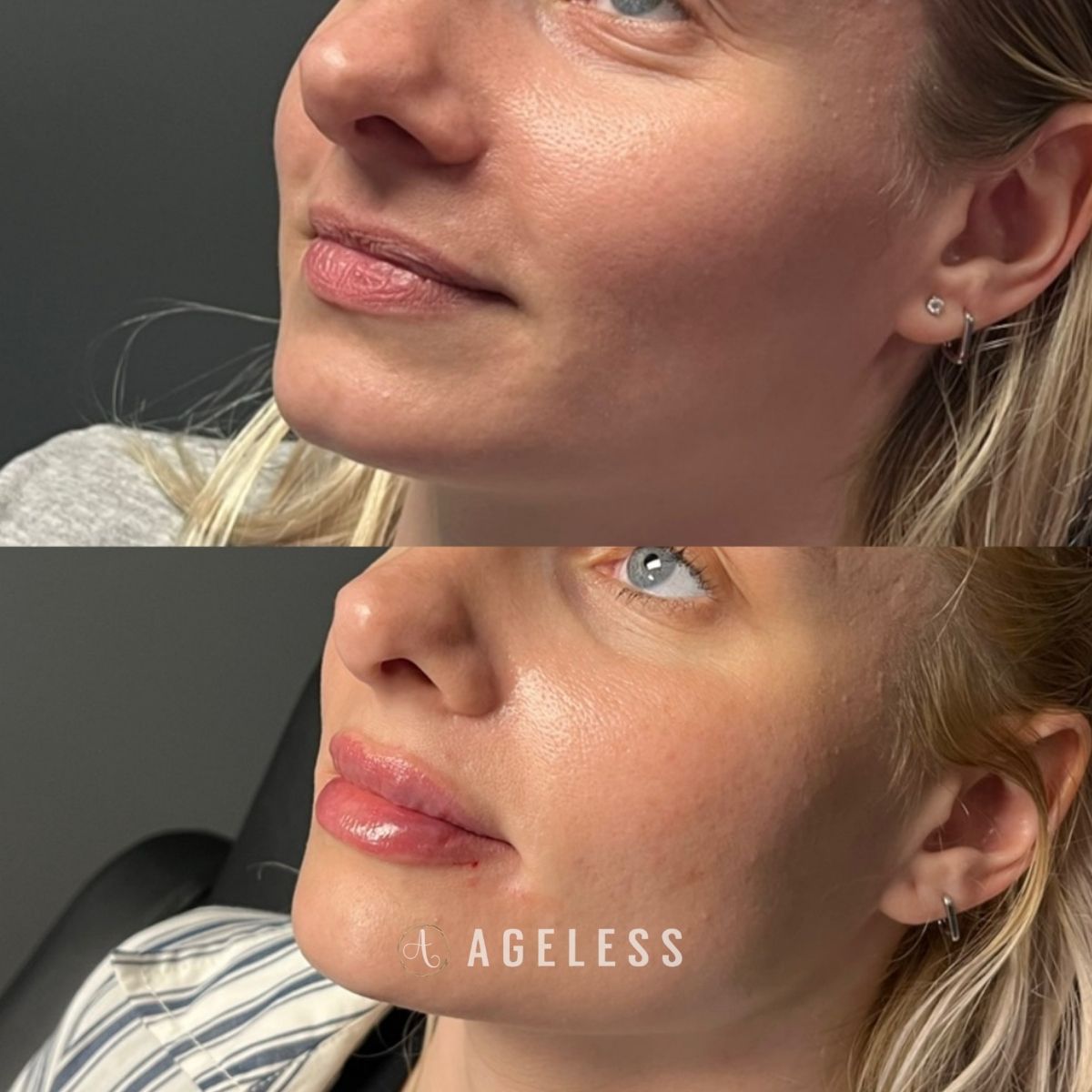 Lip filler before and after