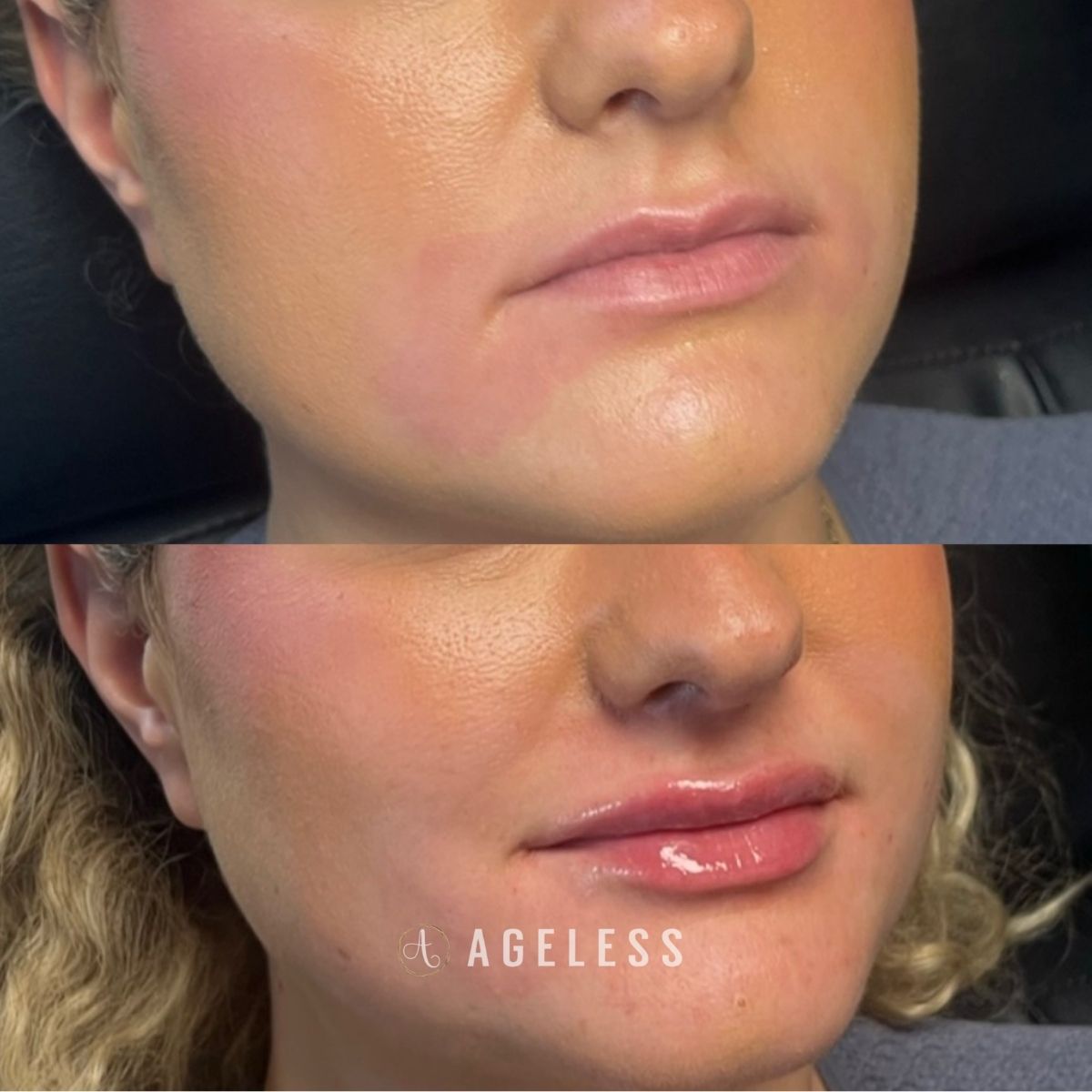 Lip filler before and after