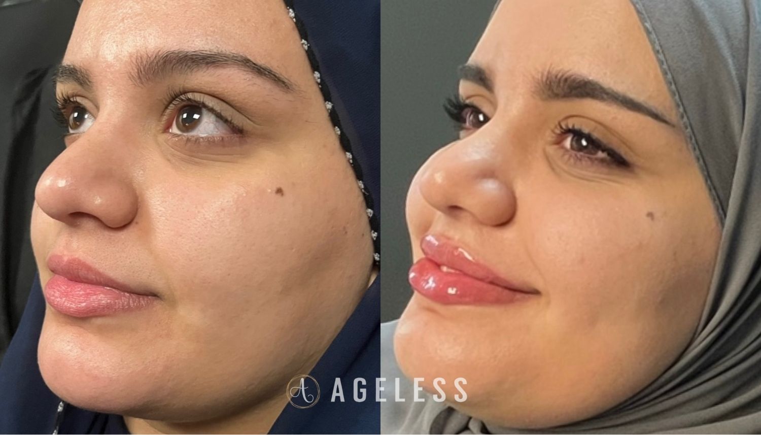 Lip Filler before and after