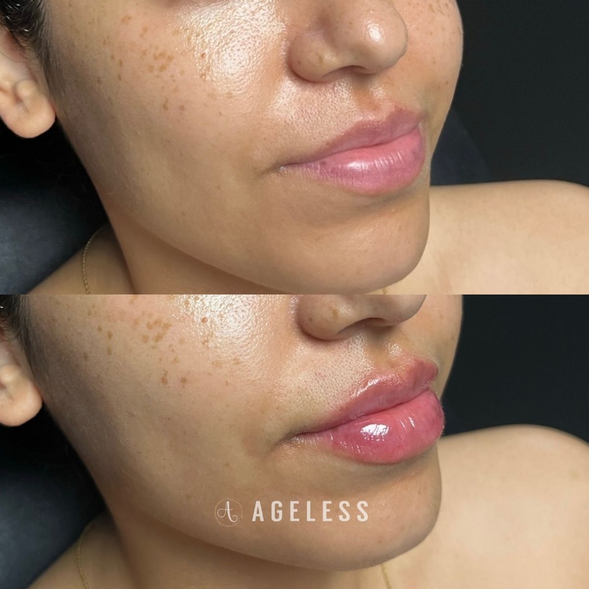 Lip filler before and after
