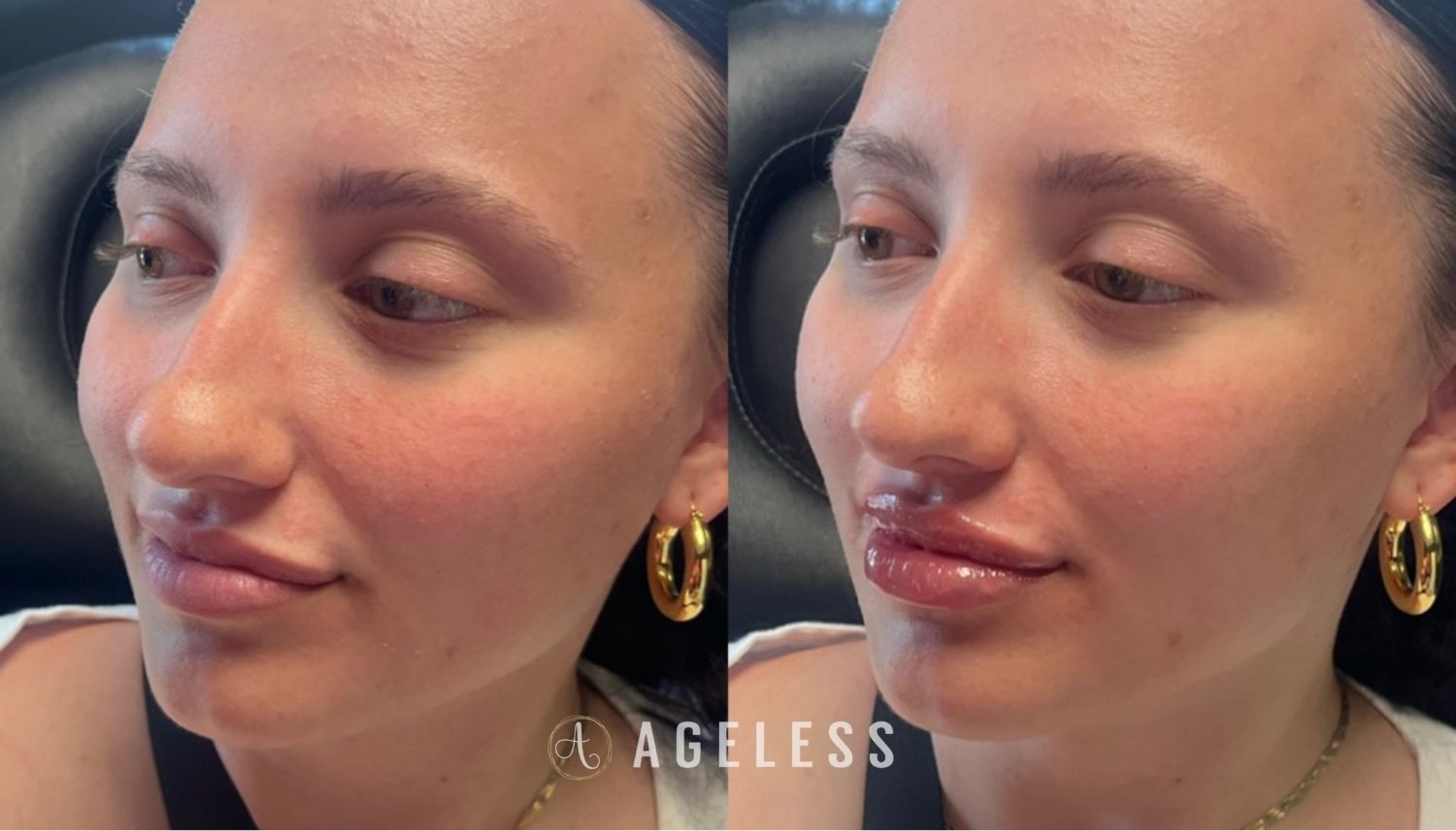 Lip Filler before and after