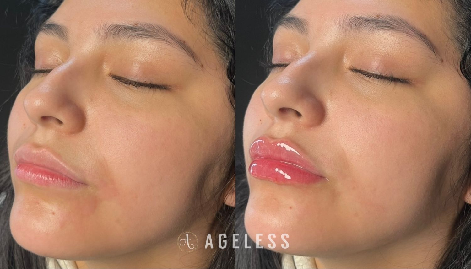 Lip Filler before and after