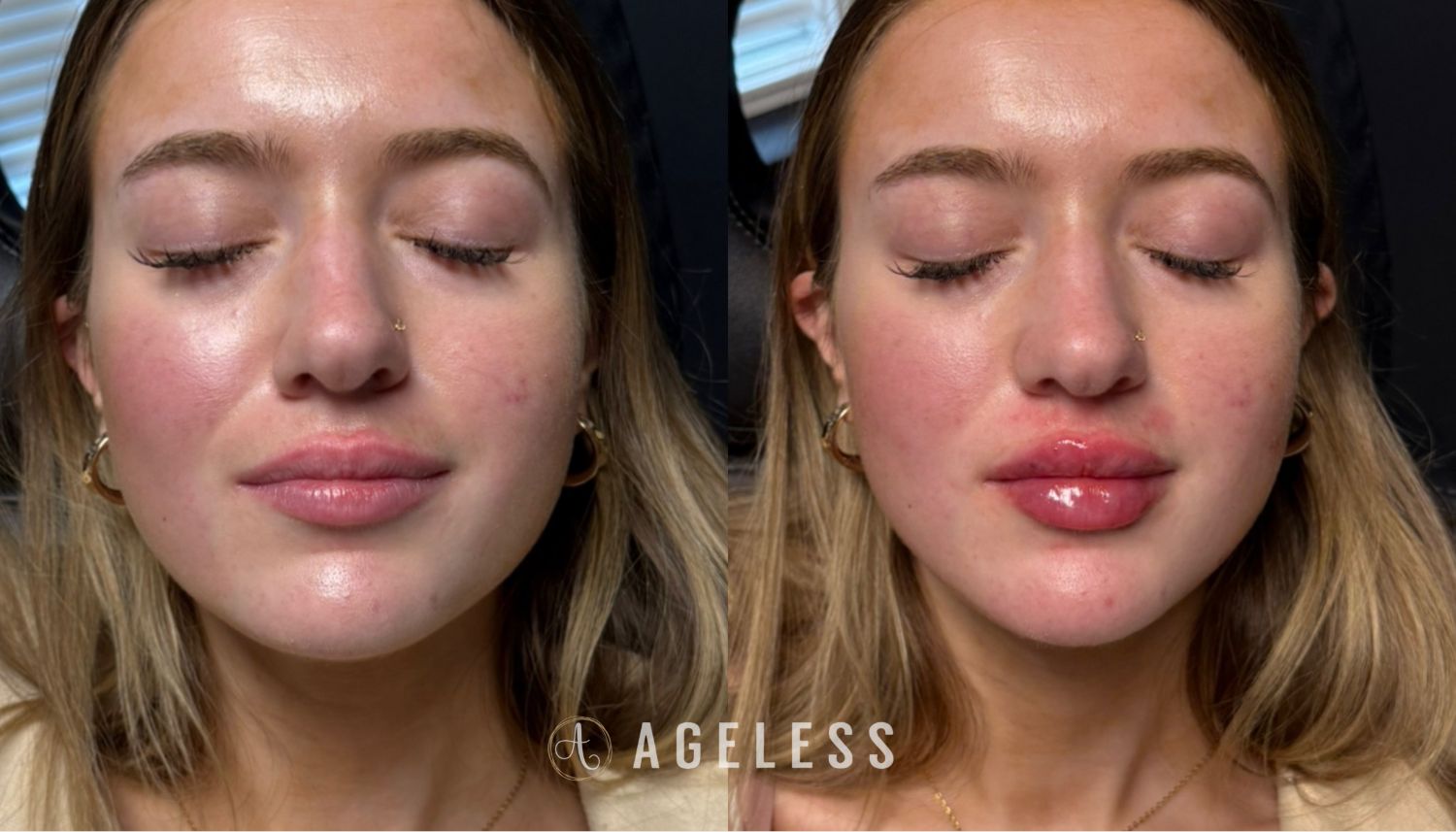 Lip filler before and after