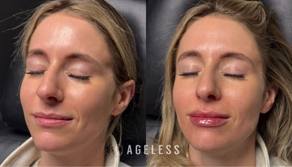 Lip filler before and after