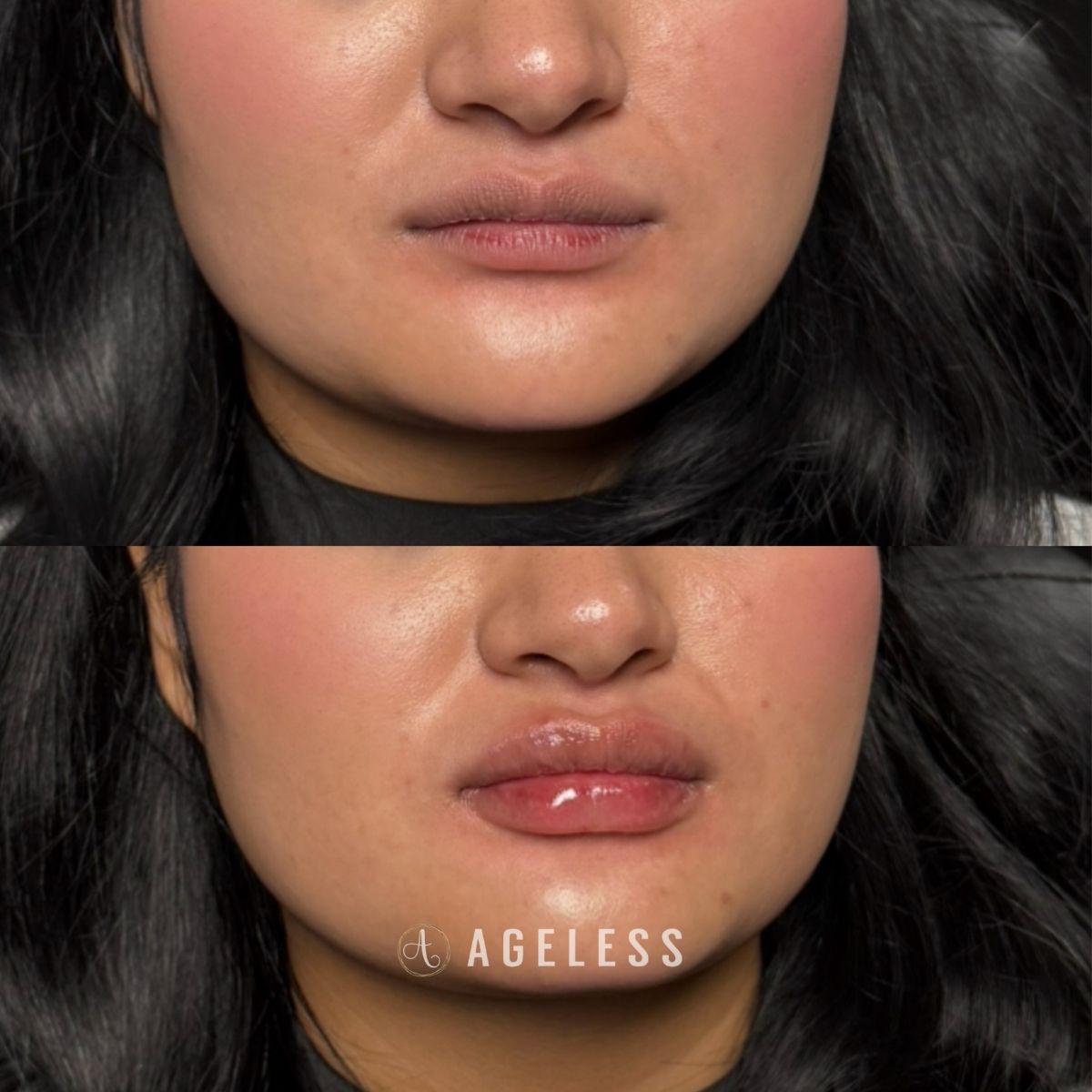 Lip filler before and after