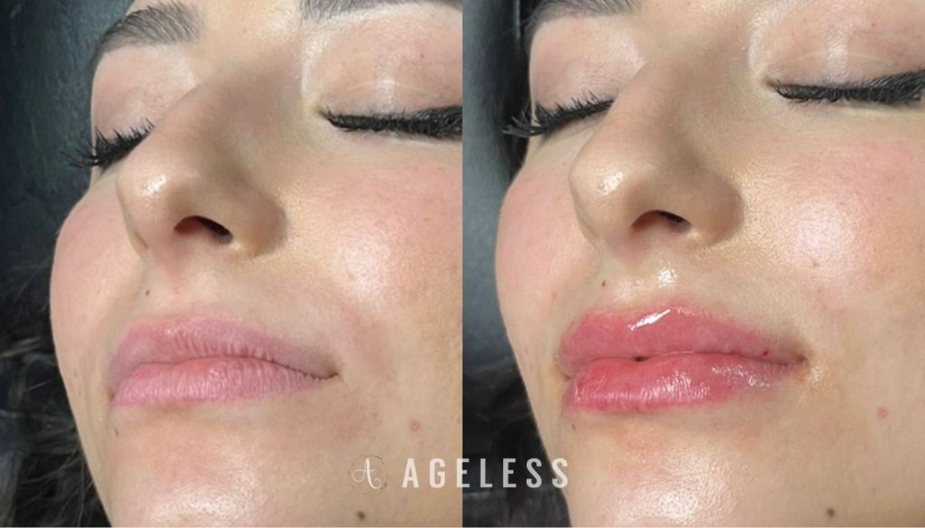 Lip Filler before and after
