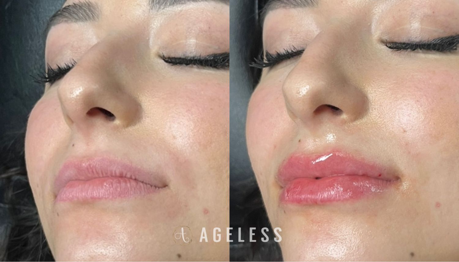 Lip Filler before and after