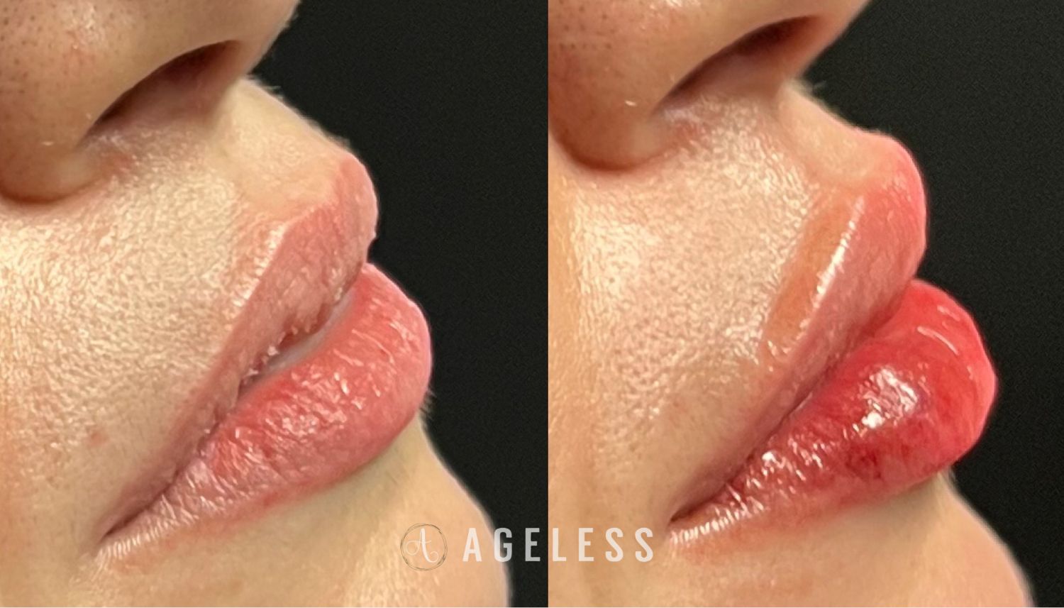 Lip filler before and after