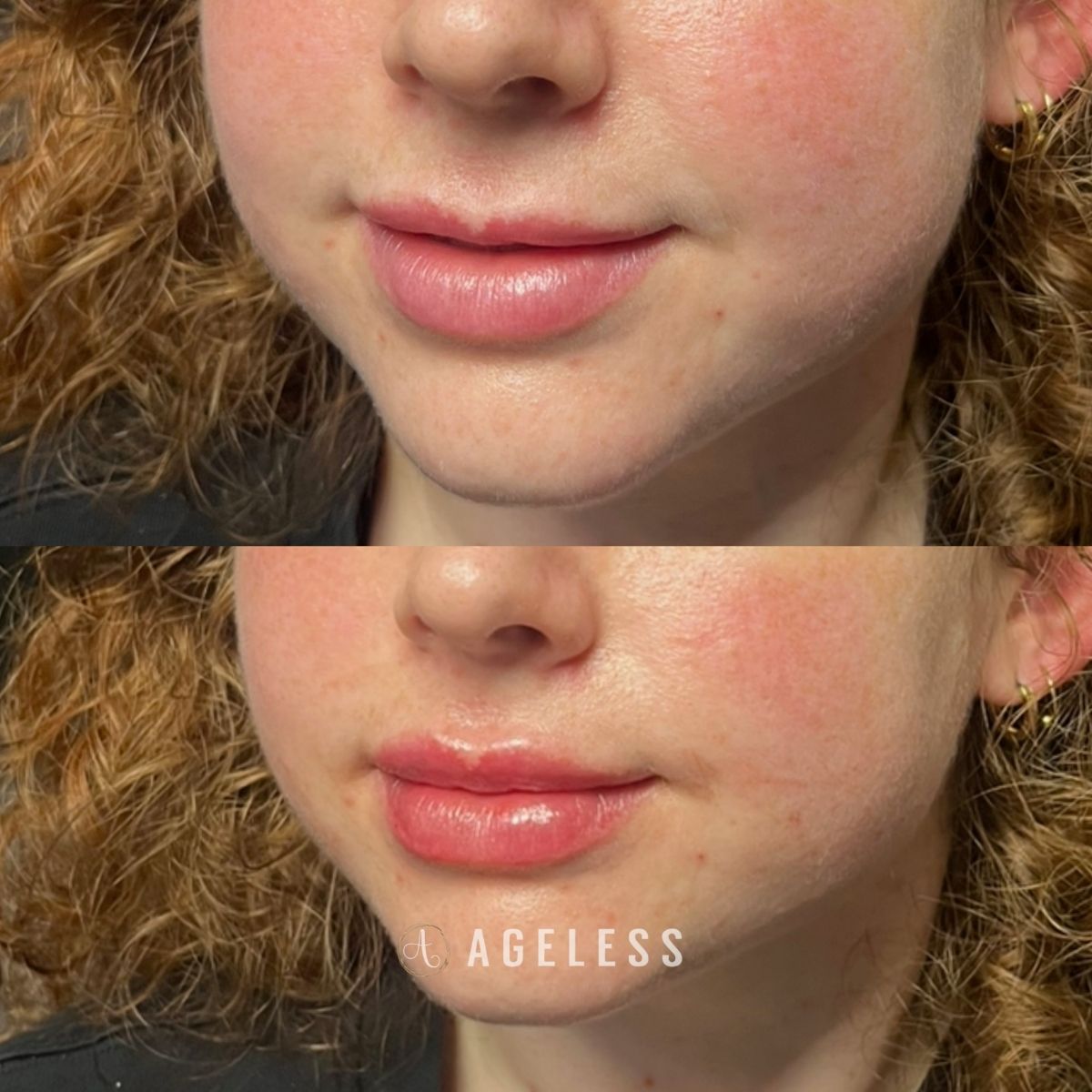 Lip filler before and after