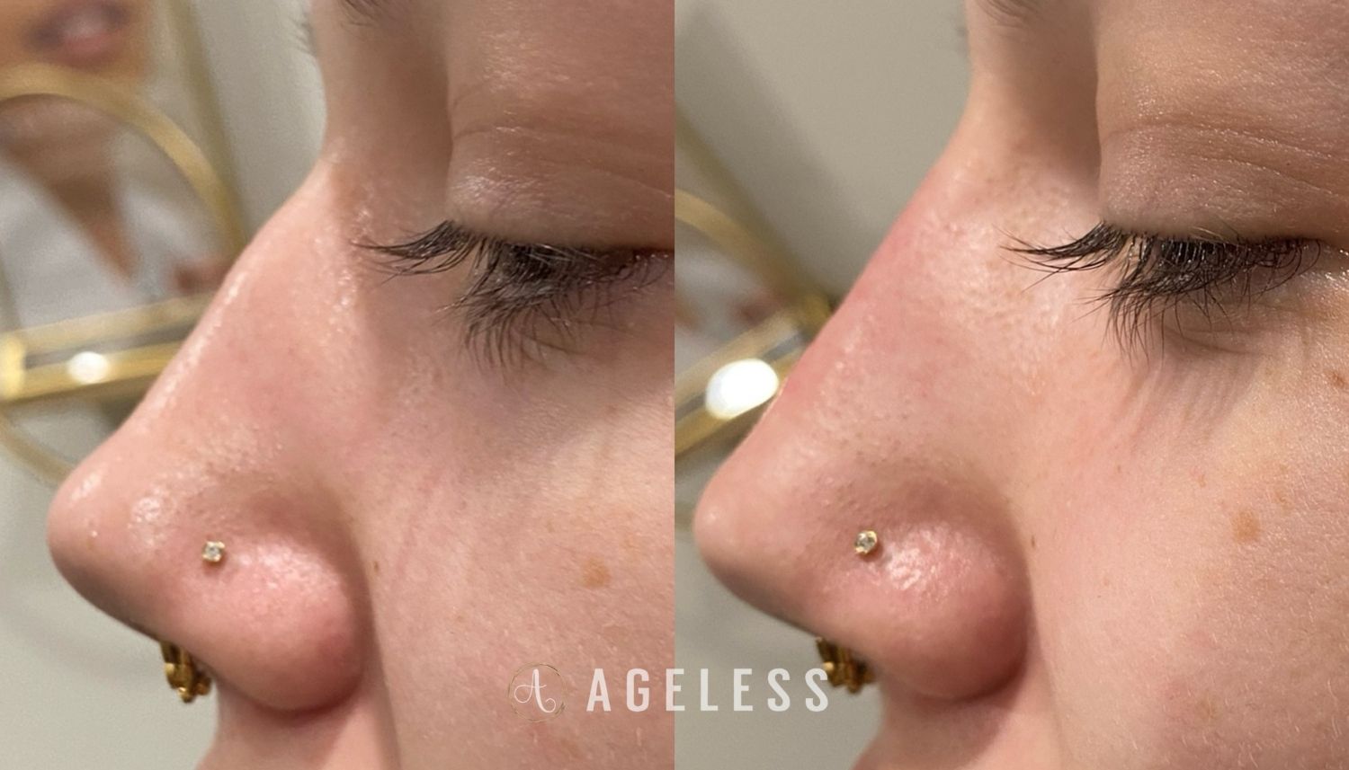 Liquid Rhinoplasty before and after
