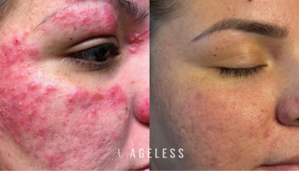 Medical Grade Skincare, CO2 laser before and after