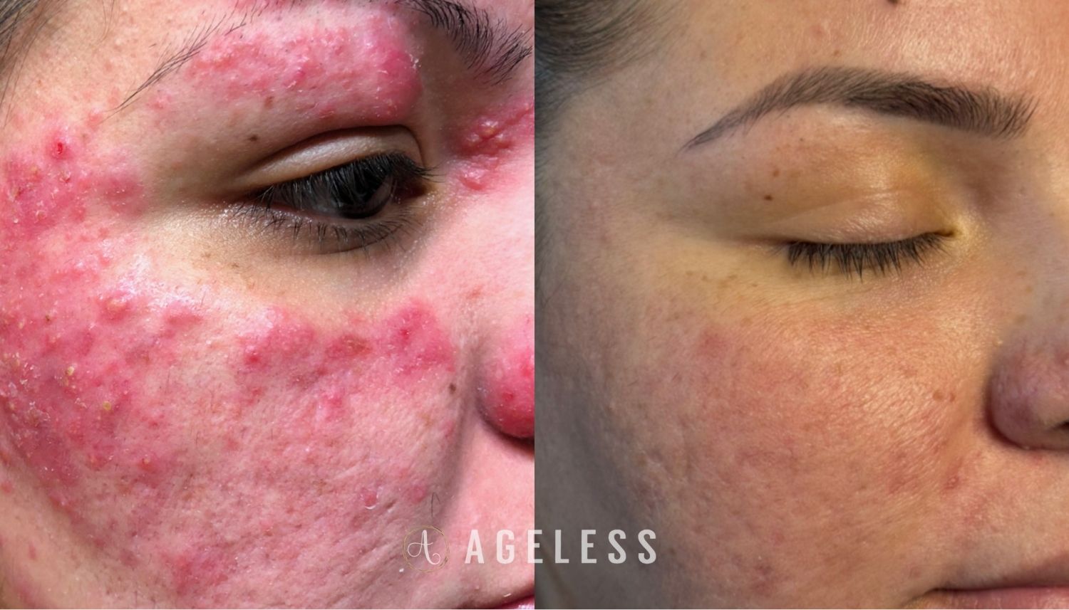 Medical Grade Skincare, CO2 laser before and after
