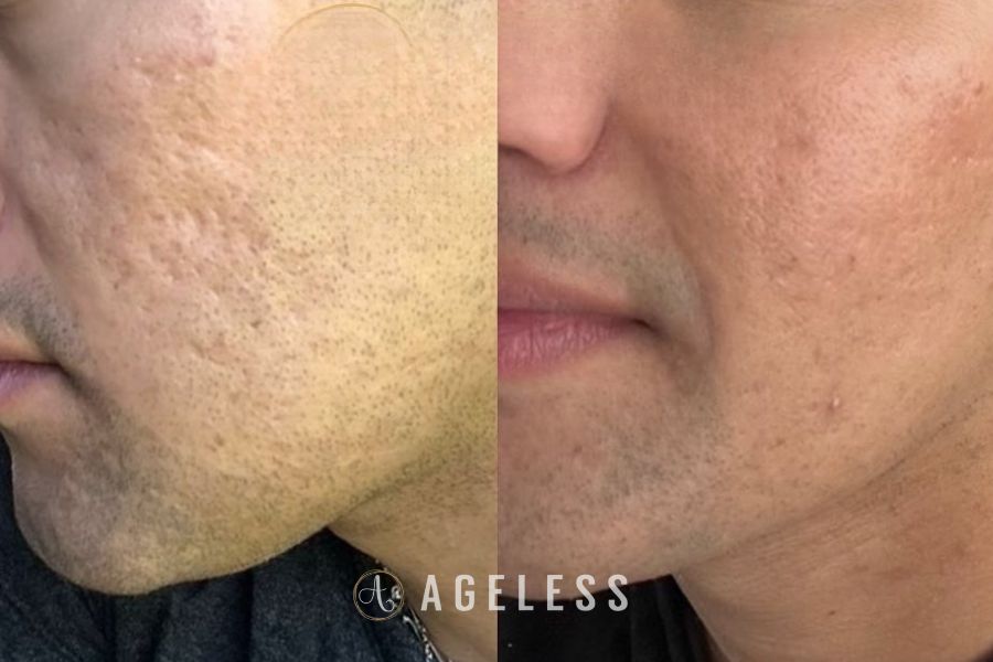 Microneedling before and after