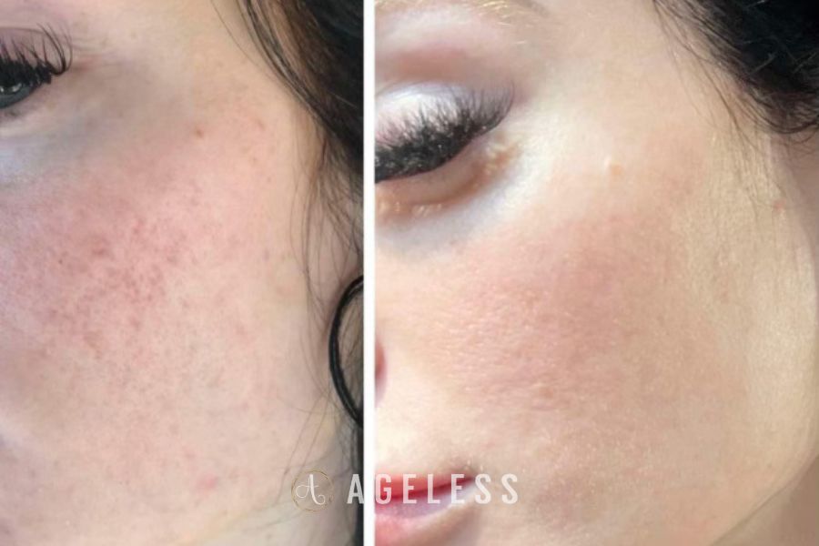 Microneedling before and after