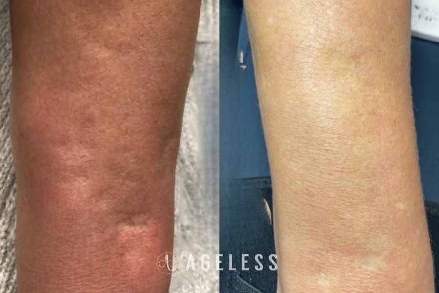 Morpheus8 RF microneedling before and after