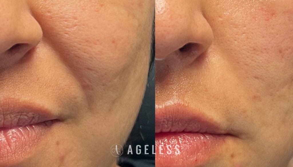 Nasolabial Fold dermal filler before and after