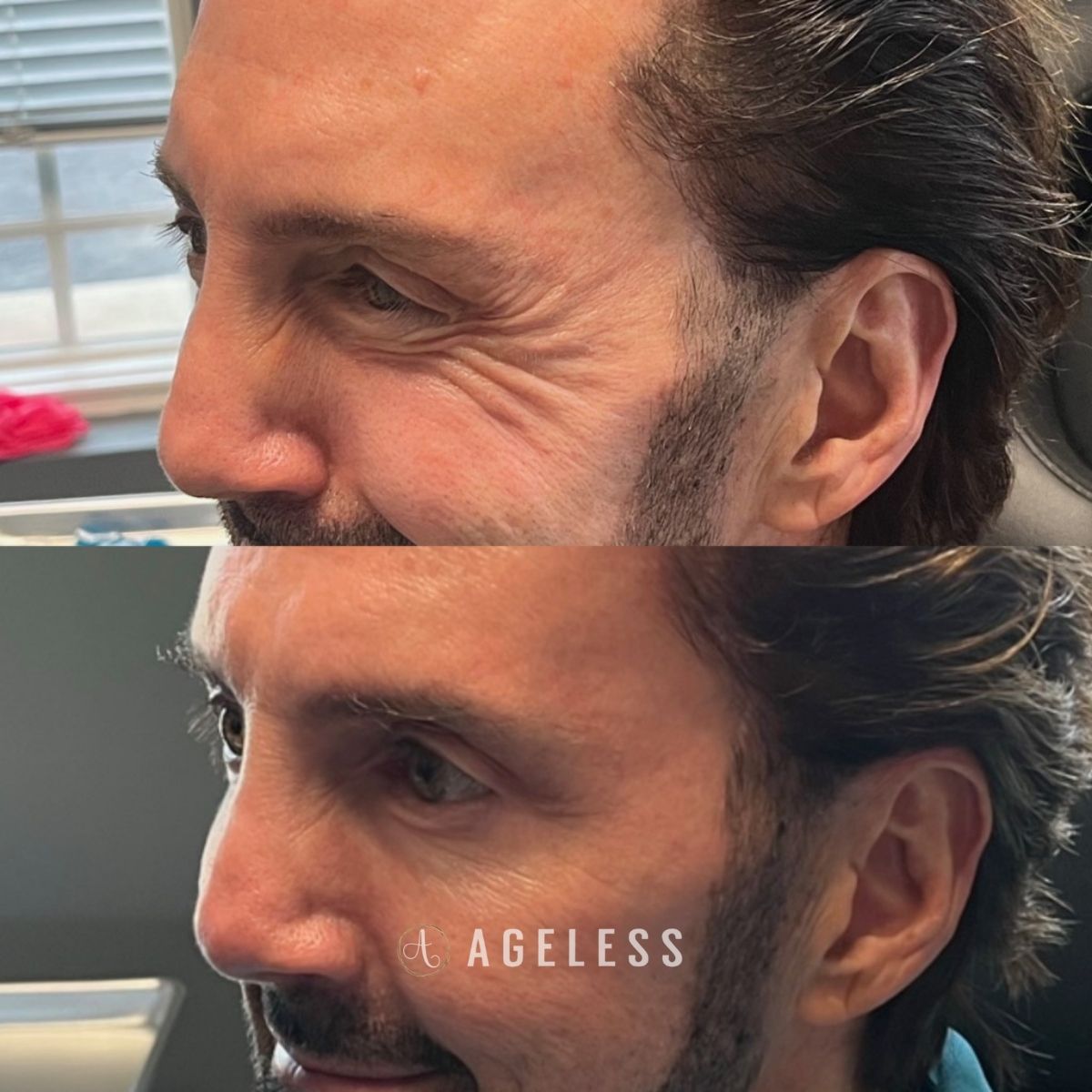 Neurotoxin crows feet before and after